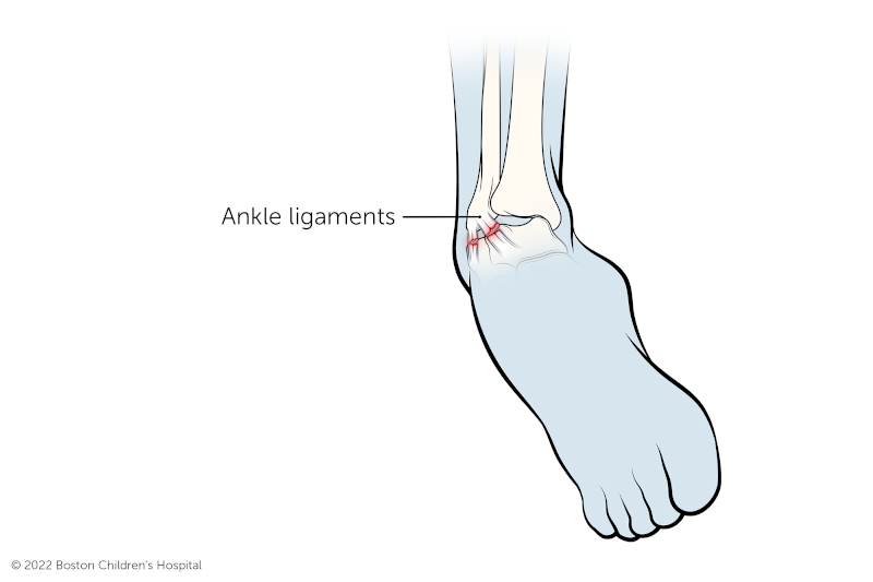 Ankle Sprain Signs & Symptoms