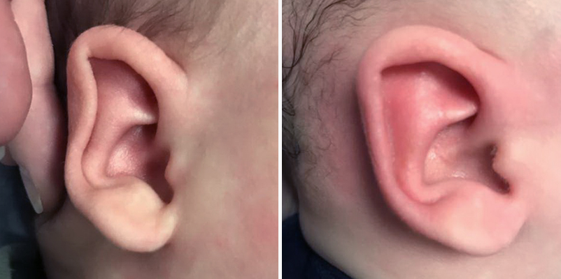 How to: Neonatal Ear Molding - ENTtoday