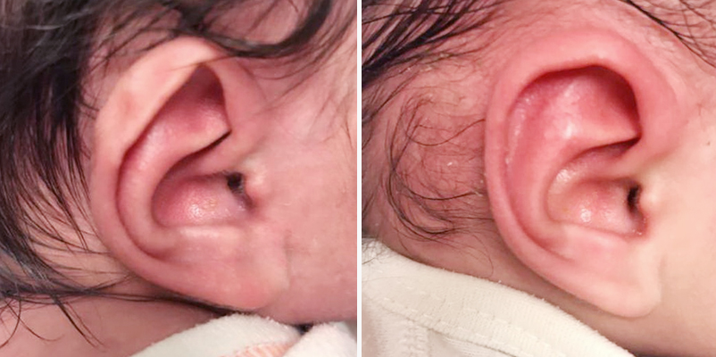 Protruding Ears - Prominent Ears - Earwell™ Infant Ear Correction System