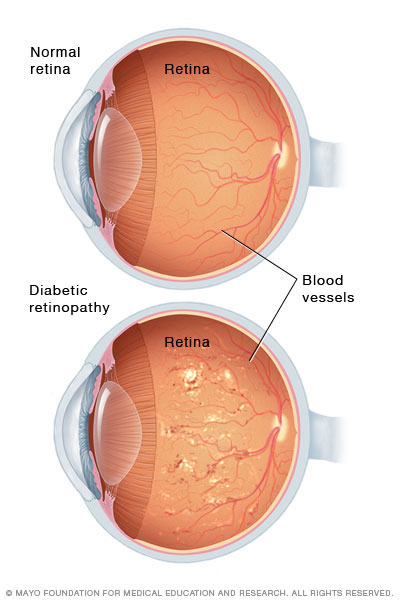 research topics in diabetic retinopathy
