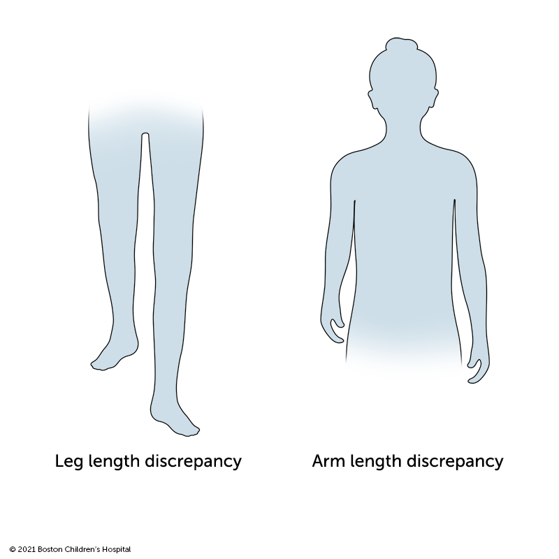 Limb Length Discrepancy  Boston Children's Hospital