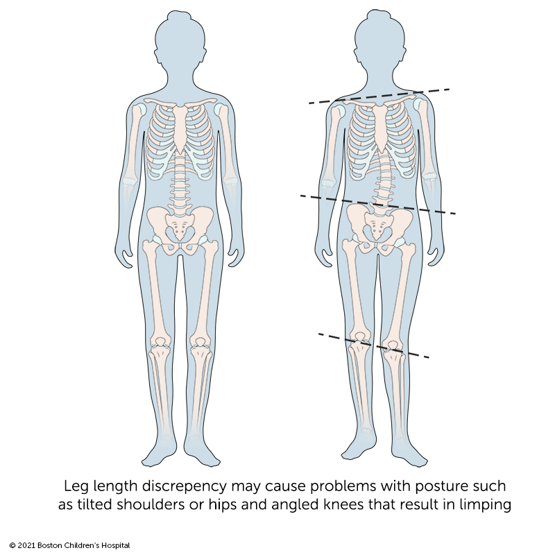 Leg Length Discrepancy Scoliosis | lupon.gov.ph