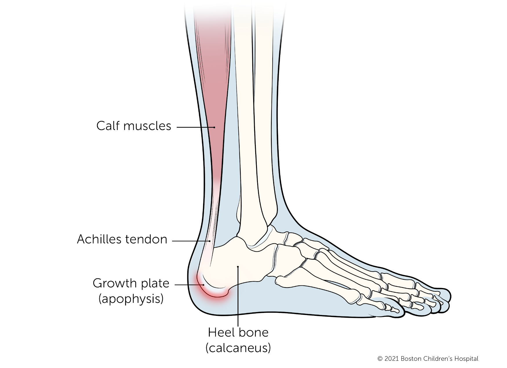 2 Major Causes of Heel Pain | Leading Edge Physiotherapy St Albert |  Edmonton Physical Therapy
