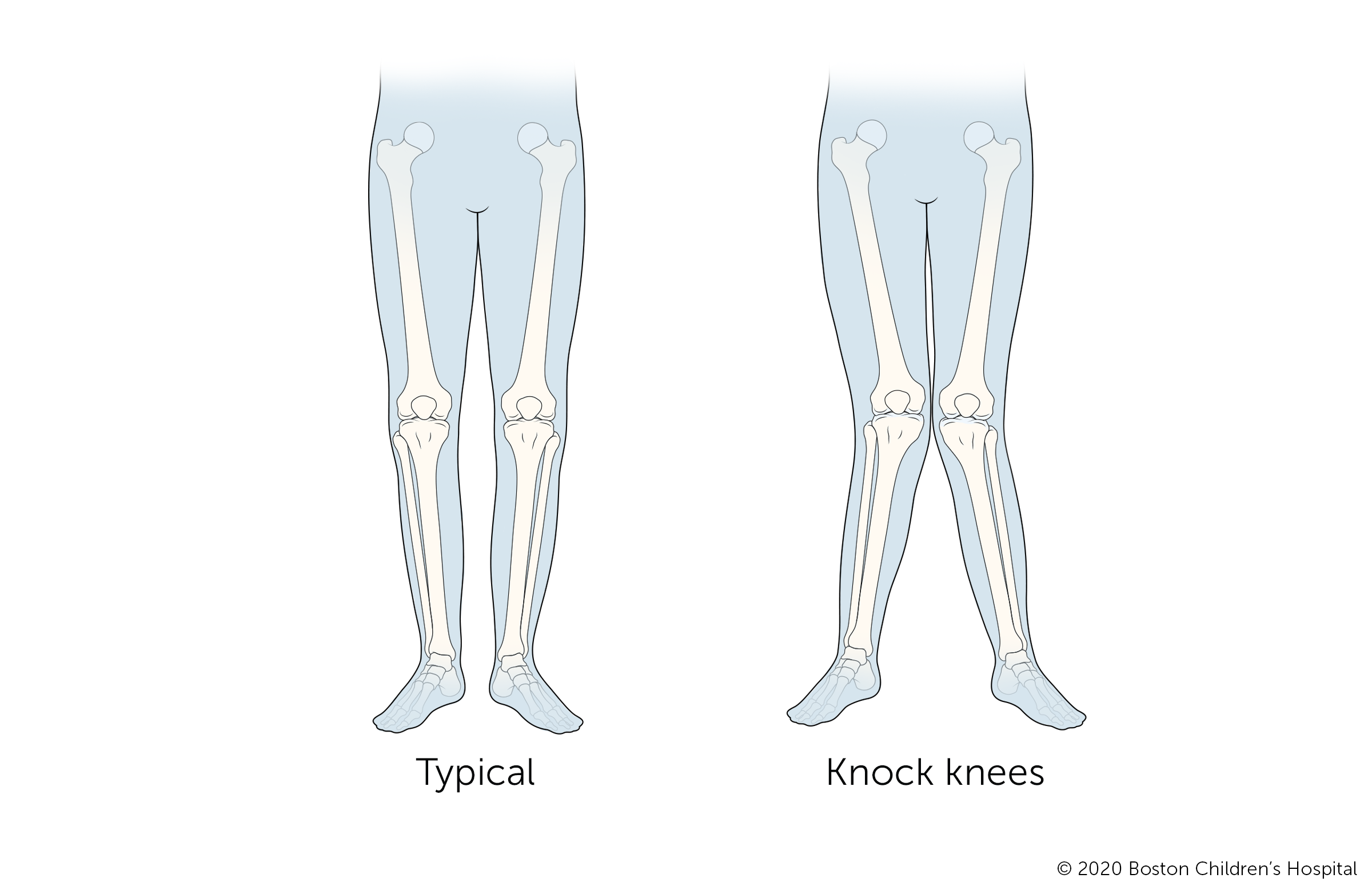 Bow Legs in Adults and Children - Causes, Symptoms & Signs