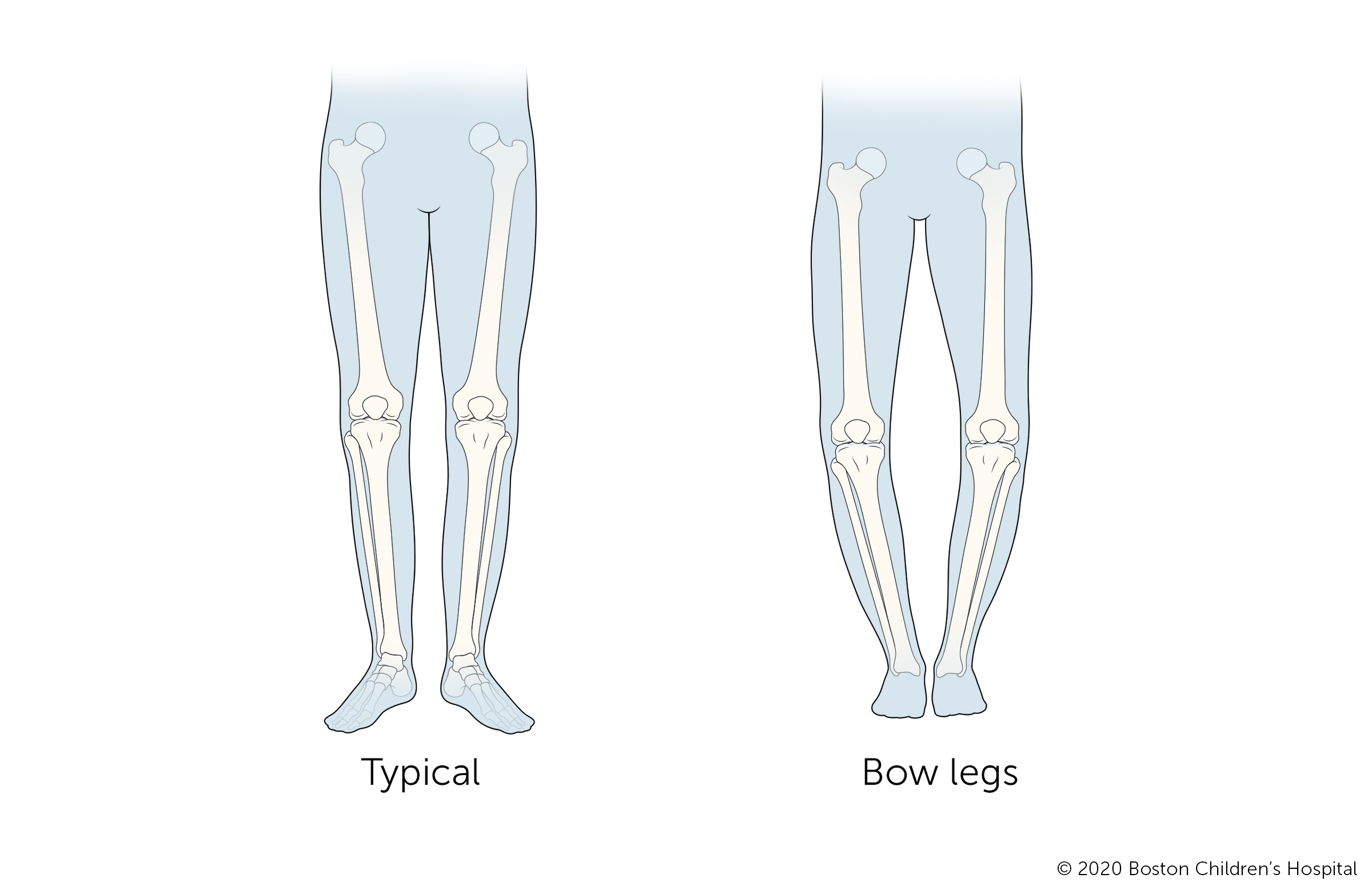 Position of the patient standing on the left leg. The right leg is