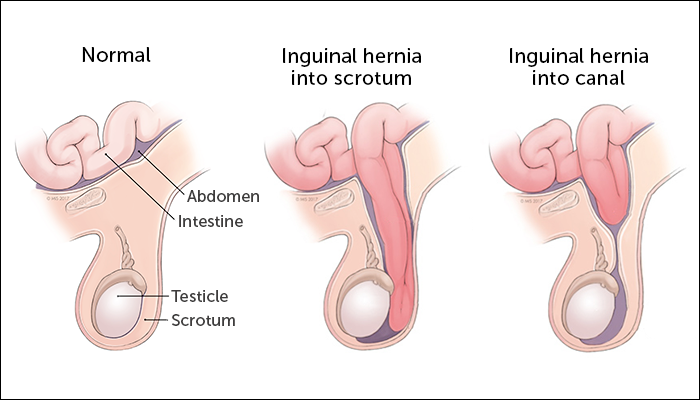 Inguinal Hernia: Is the operation necessary? Causes, Symptoms