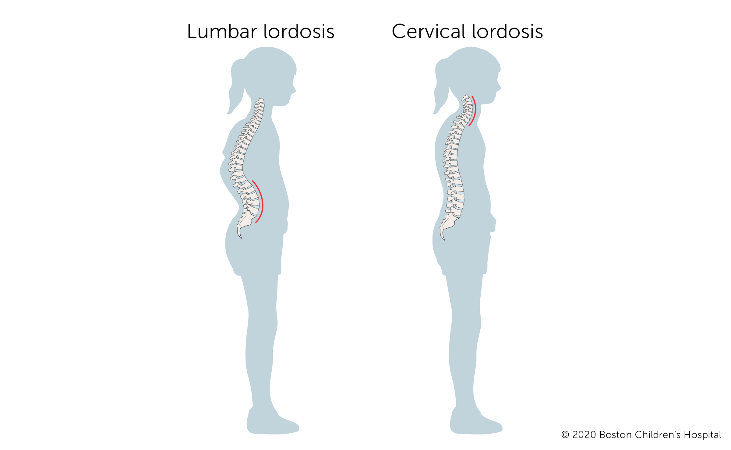 Lordosis - lumbar Information
