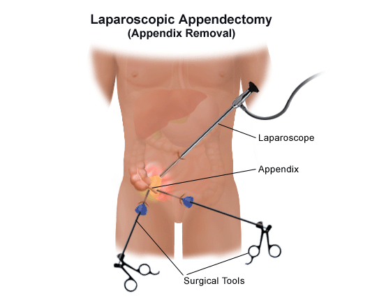 Pain appendix What Are