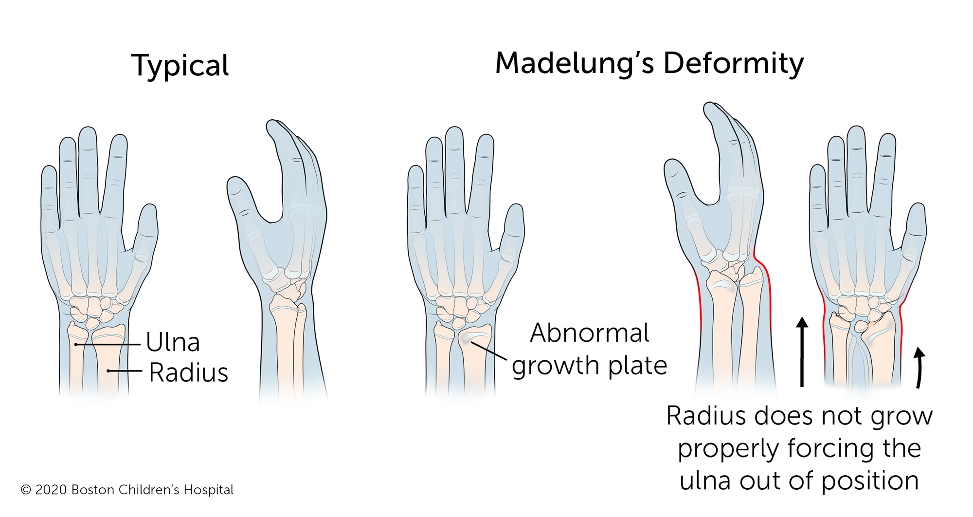 Madelungs Deformity Boston Children s Hospital