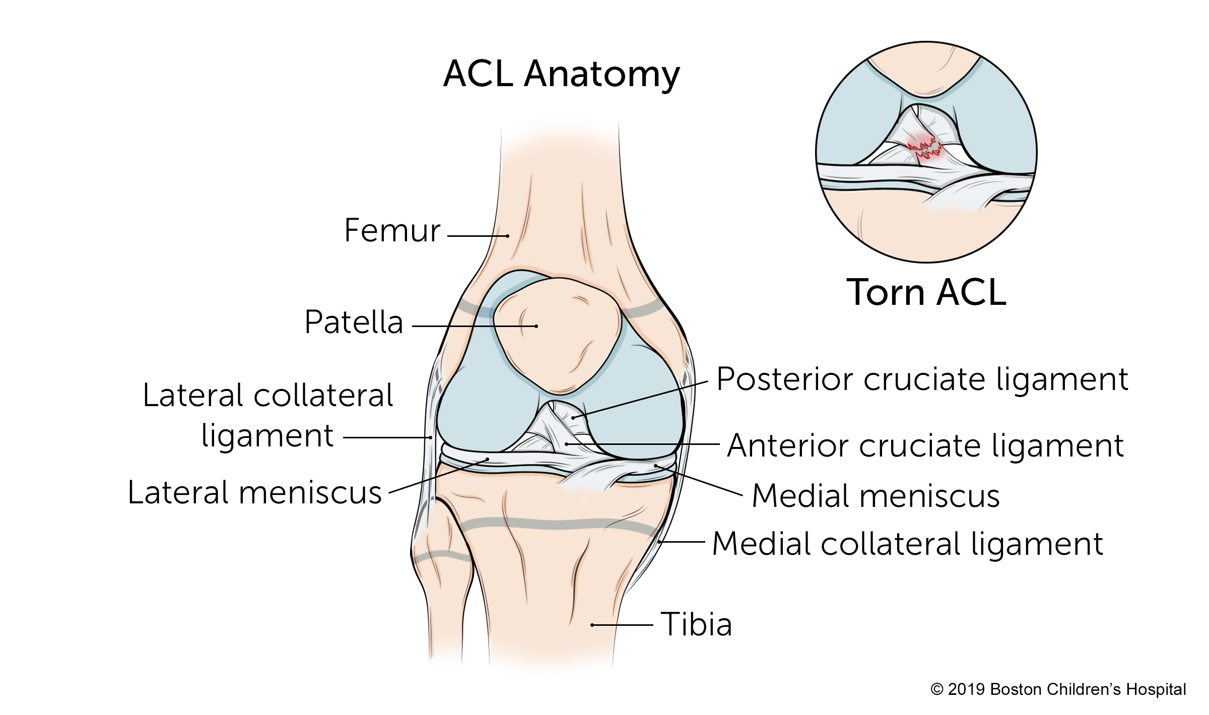 Knee Ligament Injury: Causes and Healing a Ligament tear