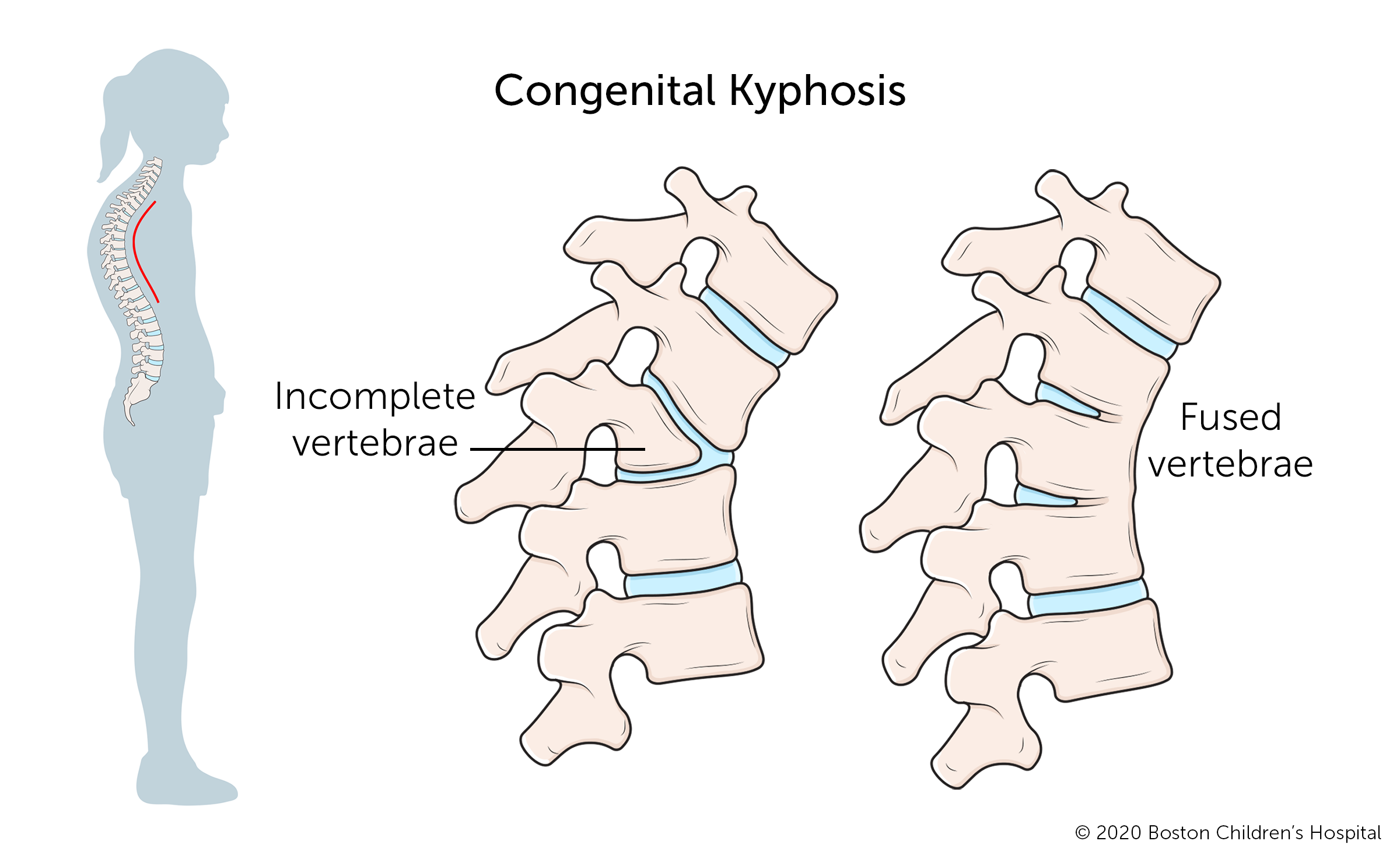 Kyphosis Boston Children s Hospital