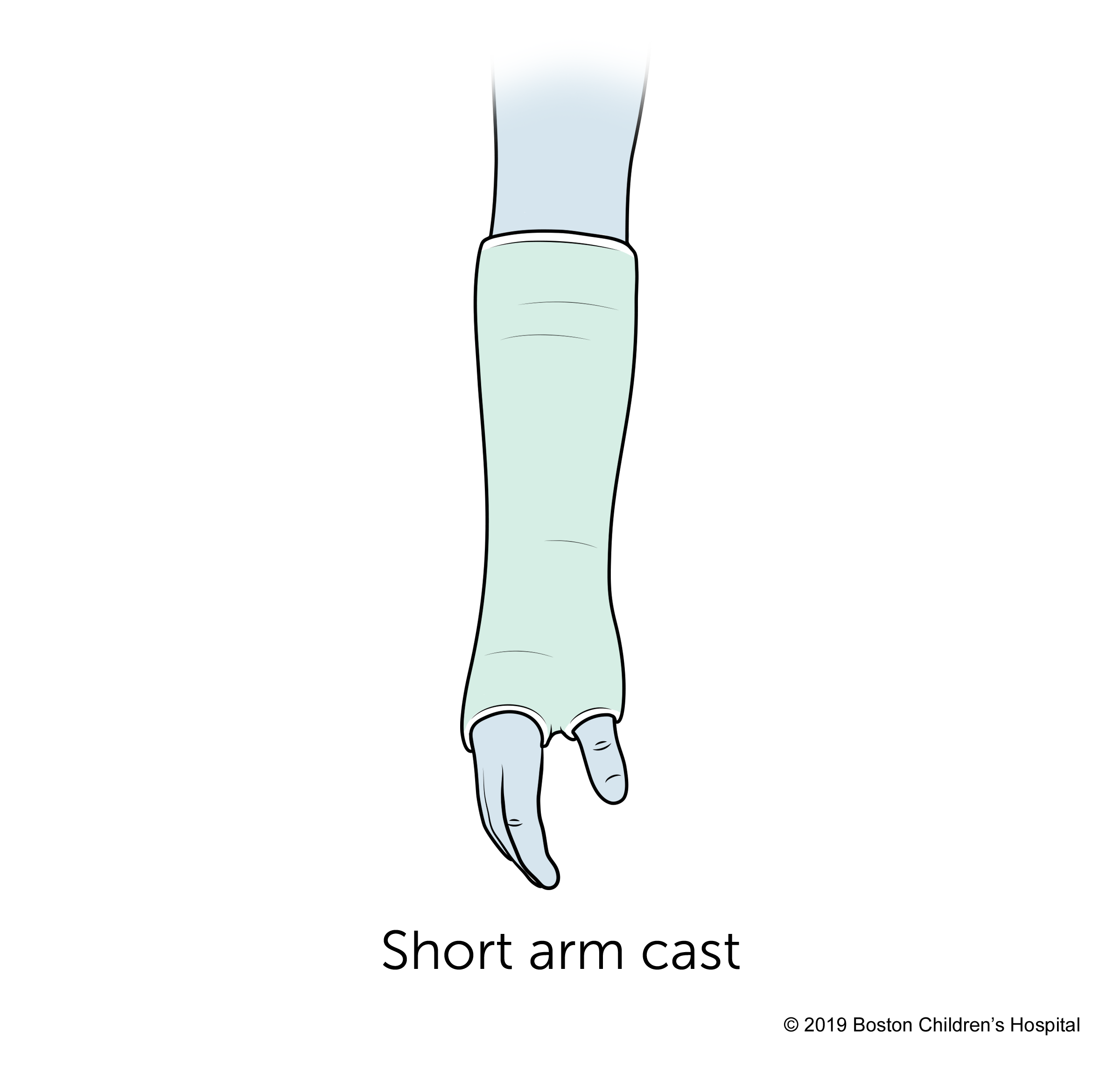 Casts: Types & Care