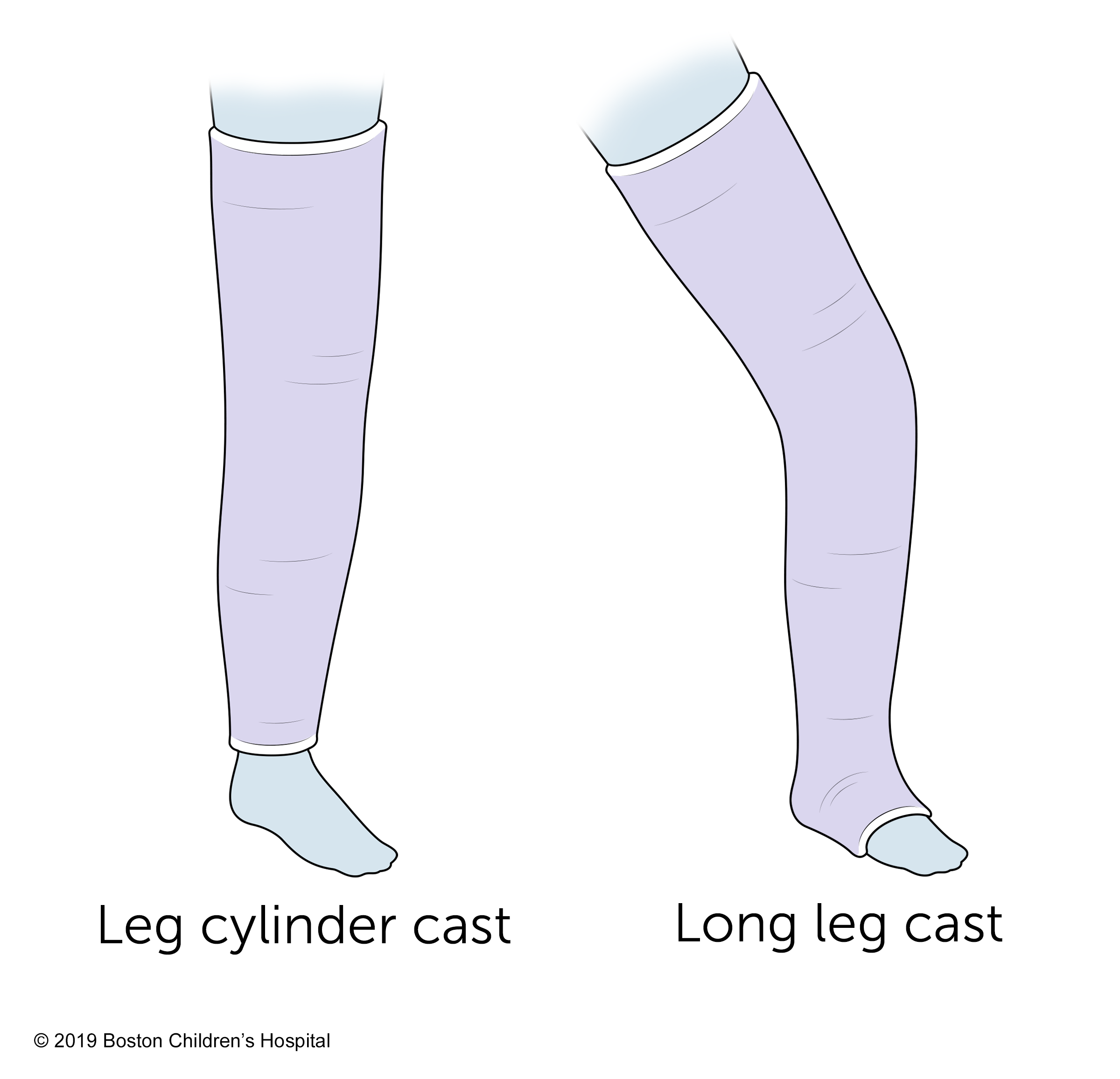 Long Leg Cast - Medical Cast