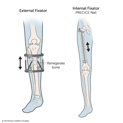 My Care Prosthetics and Orthotics on X: limb length leg length difference  leg length discrepancy suffering from short leg ? in equal leg length  difference one leg is longer than another ? #
