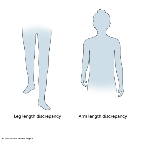 One leg longer than the other? Leg length discrepancy test and strategies 