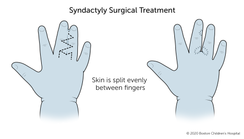 Syndactyly | Boston Children's Hospital