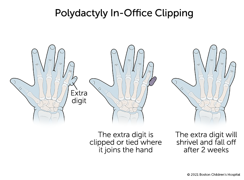 Polydactyly Boston Childrens Hospital