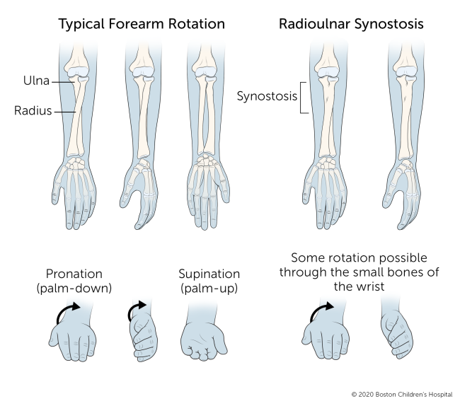 Radioulnar Synostosis | Boston Children's Hospital